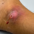 The Truth About Wound Healing: Covered or Uncovered?