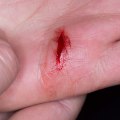 The Best Ways to Speed Up Wound Healing