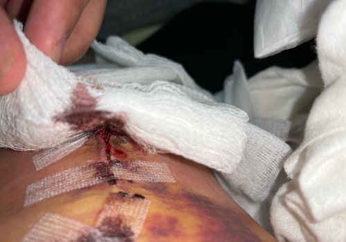 The Evolution of Wound Care: From Gauze to Modern Dressings