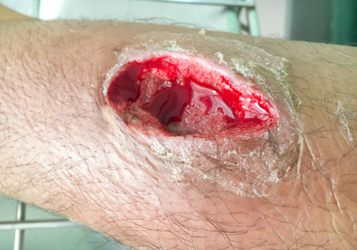 The Truth About Wound Care: To Cover or Not to Cover?