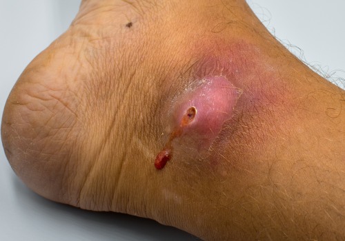 The Truth About Wound Healing: Covered or Uncovered?